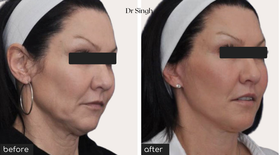 before after mini face lift nyc